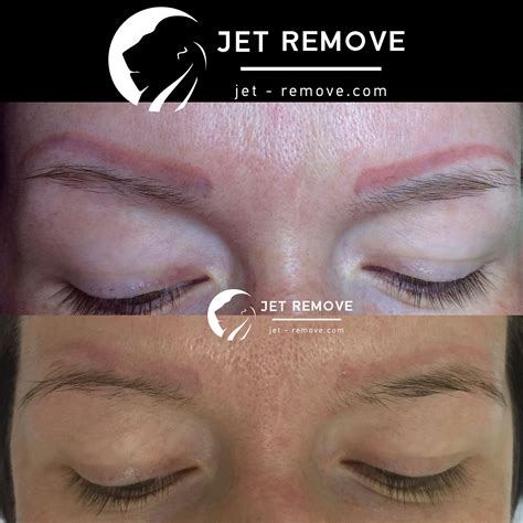 Удаление татуажа бровей тату ремувером Jet Remove