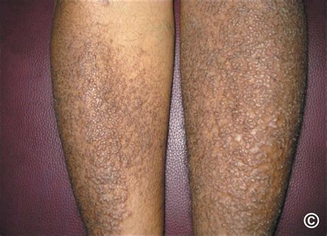 Can people survive amyloidosis? Is amyloidosis always fatal? - ABTC