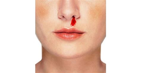 Epistaxis - New