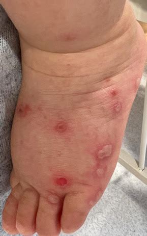 Hand, Foot and Mouth Disease - Mind The Bleep