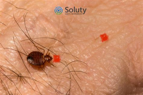 douloureux artillerie sens pommade pour piqure de punaise de lit signal