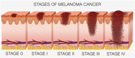 Malignant Melanoma Skin Cancer Stages