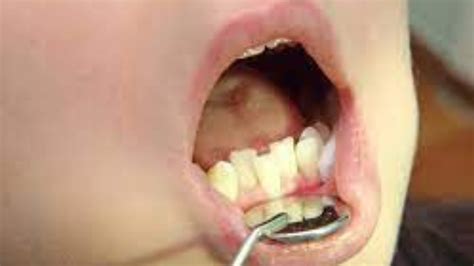 What Is Jagged Teeth: Causes And How to Fix? - Alevemente.co.uk