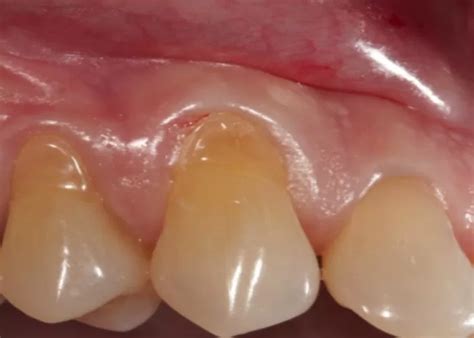 kenali gejala hingga penanganan abrasi gigi surat dokter