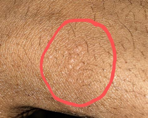 Small bumps on wrist : r/SkincareAddicts