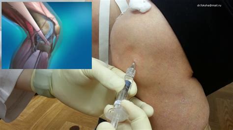 Укол гиалуроновой кислоты в коленный сустав Боль в колене Injections ...