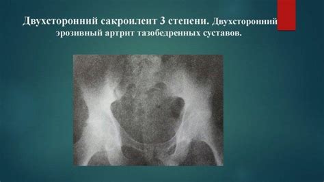 Сакроилеит левосторонний, правосторонний и двухсторонний: что это такое ...