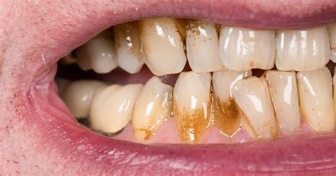 13 Causes Of Sudden Brown Stains Between Teeth & Treatment!
