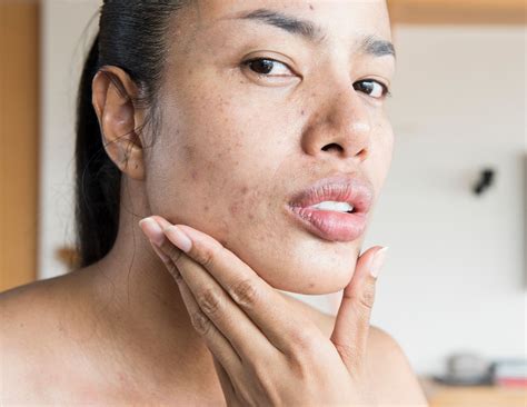 Herpes On Cheek Of Face