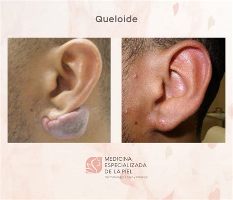 Remoção De Queloide Antes E Depois - Remoción de Queloides - Medicina Especializada en la Piel