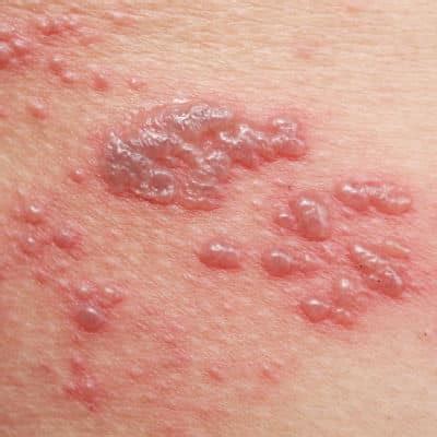 Blisters - Grand Strand Dermatology, LLC