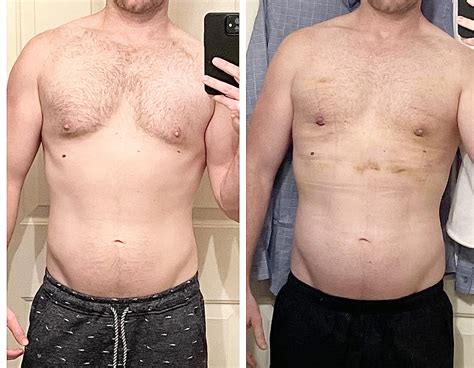 Just had gynecomastia done : gynecomastia