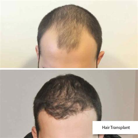 Hair Transplant In Turkey, Istanbul | Costs, Reviews 2025