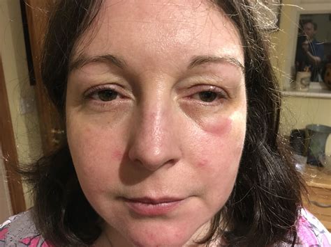 Swollen Eye Rash On Face at Charlotte Wiltshire blog