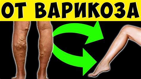 Простые упражнения от Варикоза и Боли в ногах! Эту гимнастику делают ...