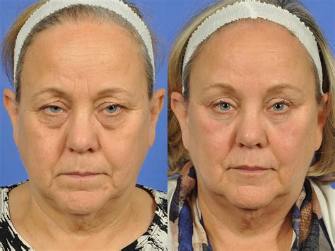 Droopy Eyelids – Ptosis Before & After Photos | Page 2 | W Cosmetic Surgery