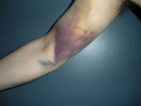 Broken humerus=not funny - Pelican Parts Forums