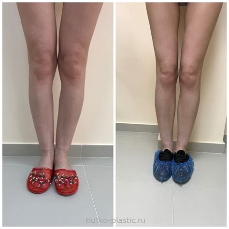 Пластика тела ДО и ПОСЛЕ - смотреть фото с отзывами | Пластический ...
