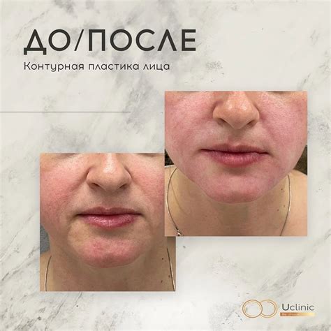 Клиника косметологии Uclinic в Волгограде - Результат после контурной ...