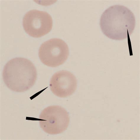 Giemsa stained blood smear photomicrograph; Giemsa stained blood smear ...