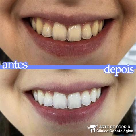 Clareamento Com Moldeira Antes E Depois - Existem diversas opções de CLAREAMENTO, que podem ser feitas no ...