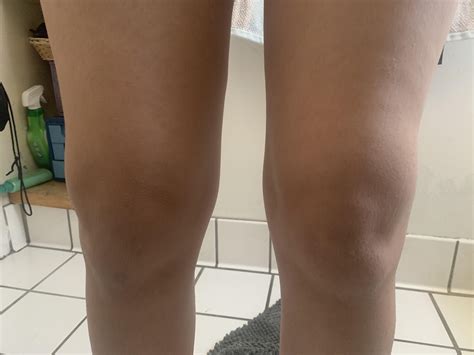 my knees are so swollen although my pain has decreased from being