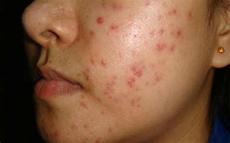 Acne Treatment - The London Skin And Hair Clinic
