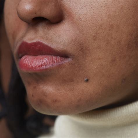 The Dermatologist's Guide To Unbelievable Blackhead Removal 2024. Image 11
