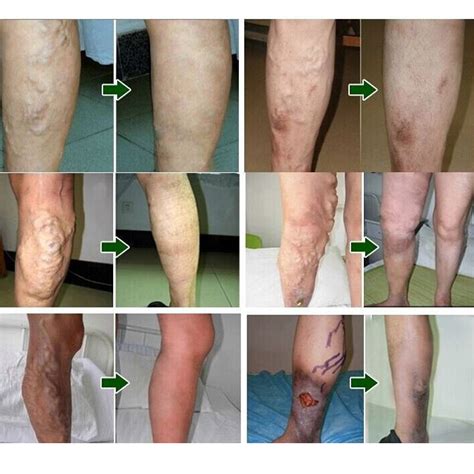 Varicose Veins Herbal Healing Patch - Not sold in stores