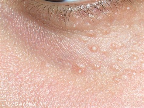 syringoma removal treatment singapore dr gerard ee