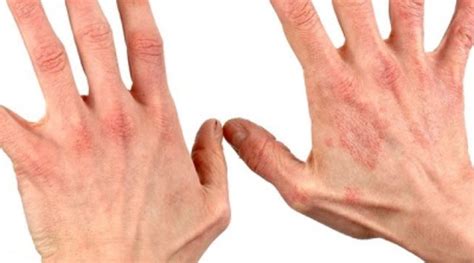 Дерматит, виды, симптомы и лечение - diagnozmed.ru