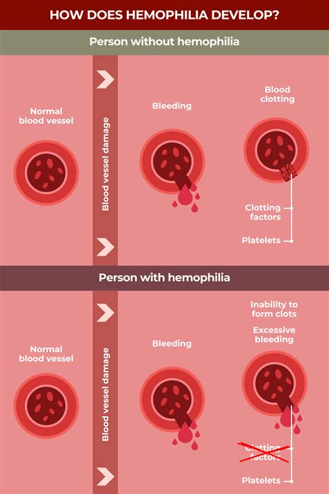 What is hemophilia? | Hemophilia News Today