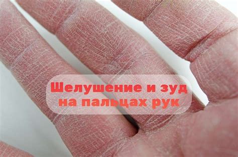 Шелушение и зуд на пальцах рук: причины и лечение