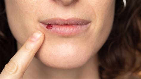 These Are the Most Common Causes of Chapped Lips - Utopia