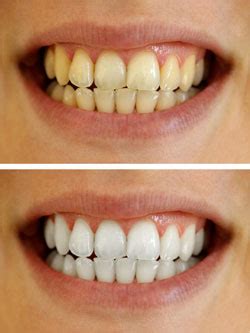 Best At-Home Teeth Whitening Methods | Randwick Dental Clinic