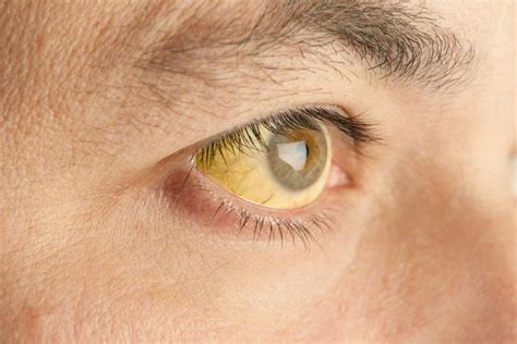 Symptoms of Jaundice in Viral Hepatitis