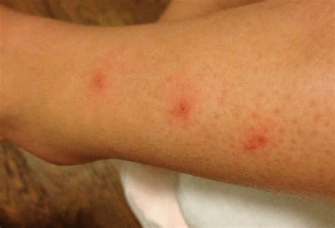 Do Carpet Beetles Bite The Truth About Beetle Bites