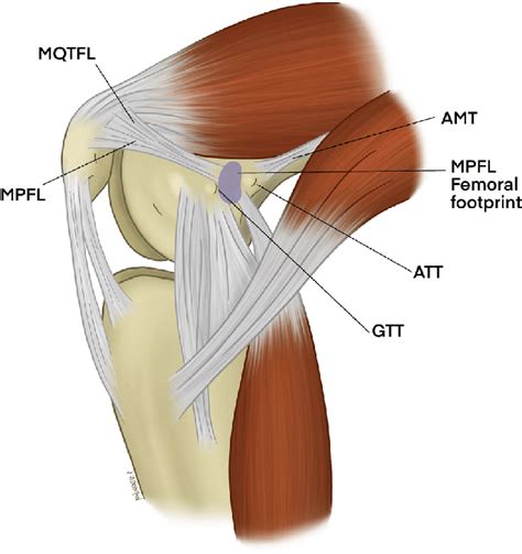 Medial Patellofemoral Ligament Injury MPFL Tear MPFL Insufficiency Orthopedic Knee Specialist ...