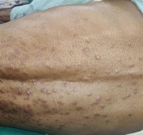 Cherry red hemangioma on back of the patient. | Download Scientific Diagram