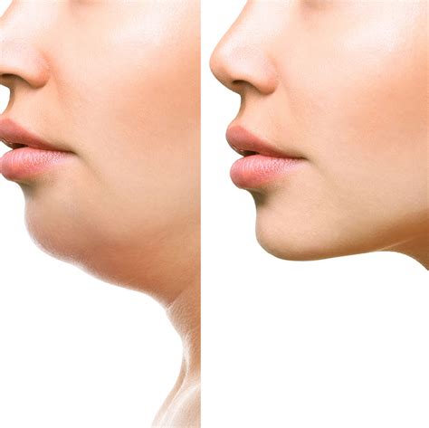 Platismoplastia - MFG Odontologia