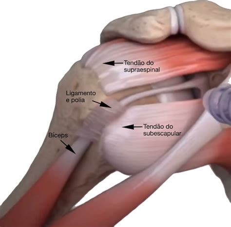 Como É Feita A Cirurgia De Tendão Do Ombro - Cirurgia para reparação da lesão dos tendões do manguito rotador — Dr ...