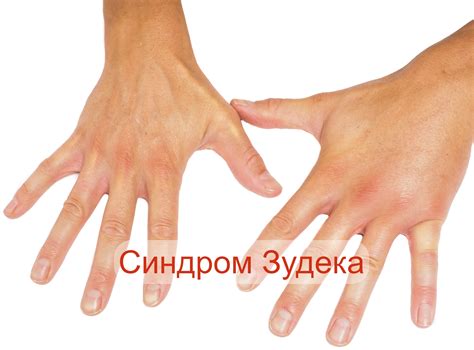 Синдром Зудека после перелома причины, симптомы, лечение и ЛФК