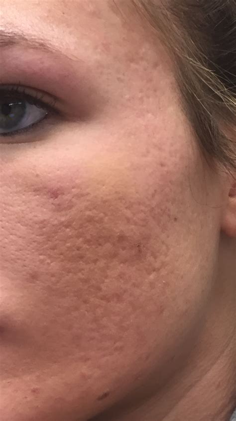 How severe are my acne scars? – Scar treatments – Acne.org Forum