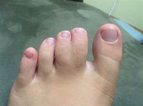 My webbed toes. Its on the same toes and is the same length of webbing ...