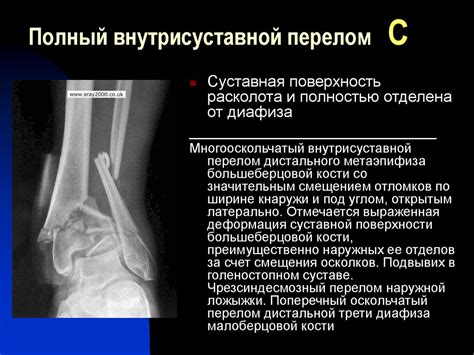 Переломы плечевой кости - online presentation