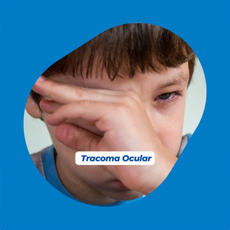 TRACOMA OCULAR – AMP – Soluções Terapêuticas
