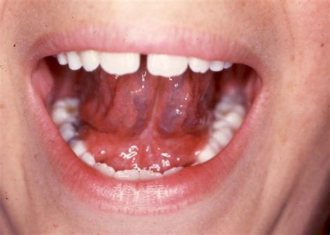 normal  tongue