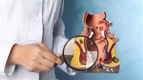 What Is A Fistula? Understanding The Basics