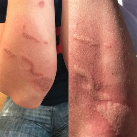 Box Jellyfish Sting Scars