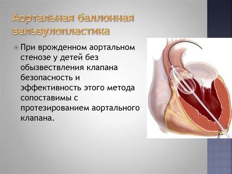Аортальный стеноз - презентация онлайн